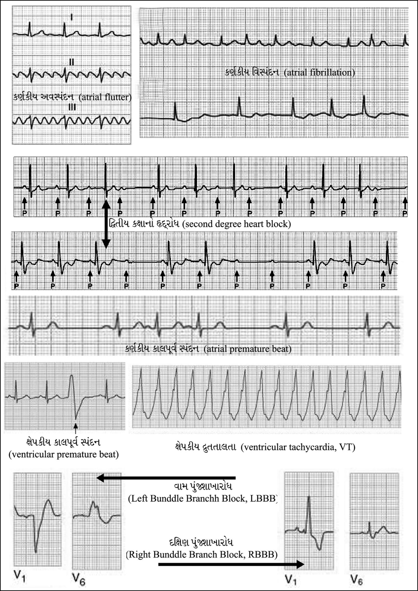  cardiac Arrhythmia Gujarati Vishwakosh 